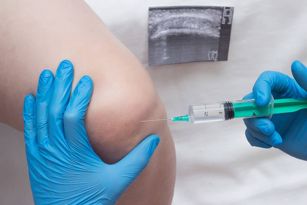 Closeup Of A Rheumatologist Injecting A Needle Into A Patient’s Knee Steroid Joint Injections